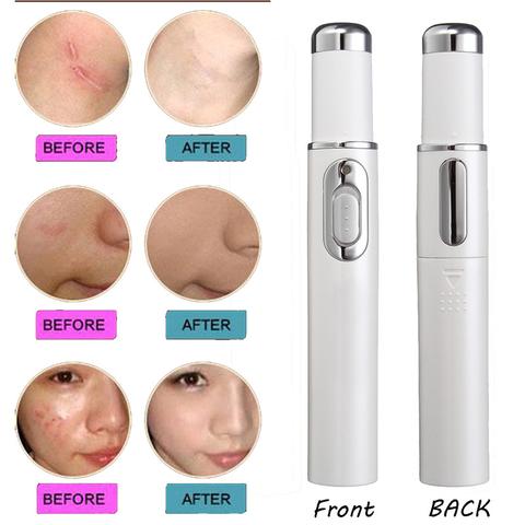 Blue Light Therapy Acne Laser Pen Soft Scar Wrinkle Removal Treatment Device